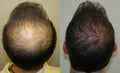 Advanced Hair Growth Roll-On Serum